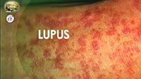 https://healinggaling.ph/ph/wp-content/uploads/sites/5/2016/04/lupus-wpcf_200x113.png