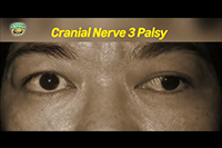 http://healinggaling.ph/ph/wp-content/uploads/sites/5/2017/05/cranial-nerve-3-palsy.png