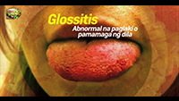 https://healinggaling.ph/ph/wp-content/uploads/sites/5/2017/08/glossitis-wpcf_200x113.png