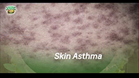 http://healinggaling.ph/wp-content/uploads/2017/04/Skin-Asthma-wpcf_200x113.png