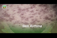 http://healinggaling.ph/wp-content/uploads/2017/04/Skin-Asthma.png