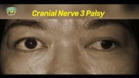 http://healinggaling.ph/wp-content/uploads/sites/5/2017/05/cranial-nerve-3-palsy-wpcf_200x113.png